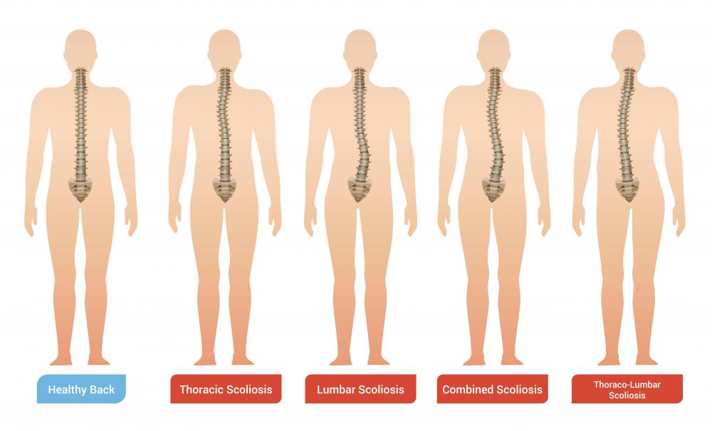 Escoliosis en adultos mayores: problemas derivados y ejercicios recomendables