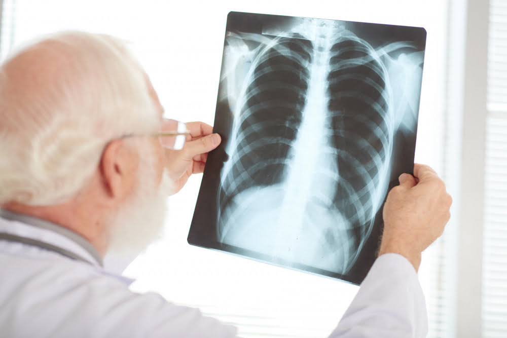 ¿Qué son la pulmonia y neumonia? ¡Descúbrelo todo sobre ellas!